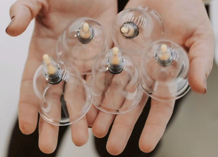 Open hands holding five clear cupping cups with pump valves