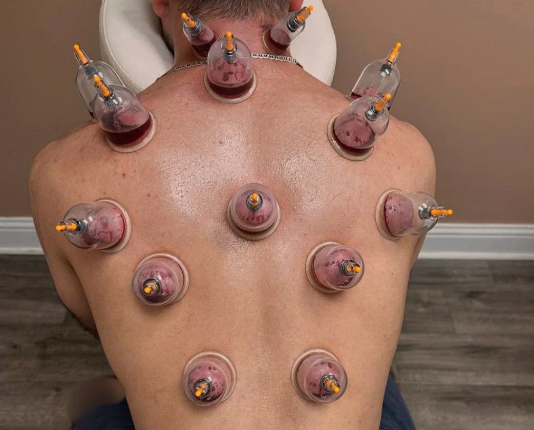 Rows of hijama cups from a client's neck down his back, each drawing a small amount of blood