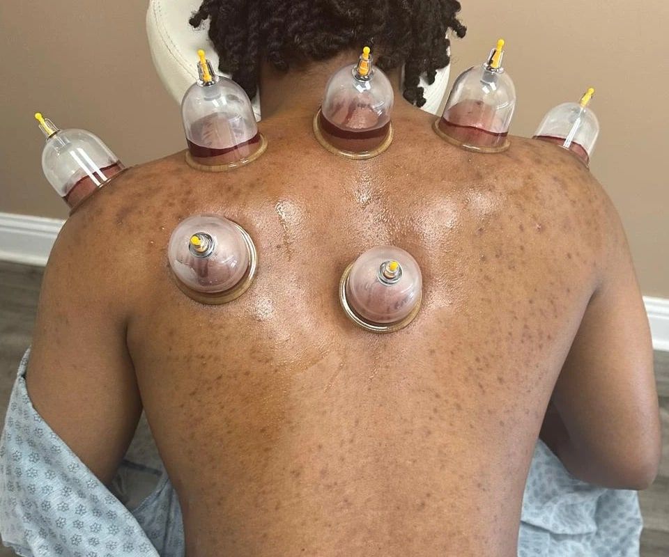Seven hijama cups along a client's neck, shoulders and upper back, each drawing a small amount of blood